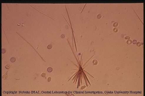 Кристаллы шарко в кале. Кристаллы билирубина в моче под микроскопом. Кристаллы билирубина в моче микроскопия. Билирубин в моче микроскопия. Кристаллы Шарко Лейдена в Кале микроскопия.